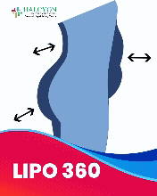 Lipo 360