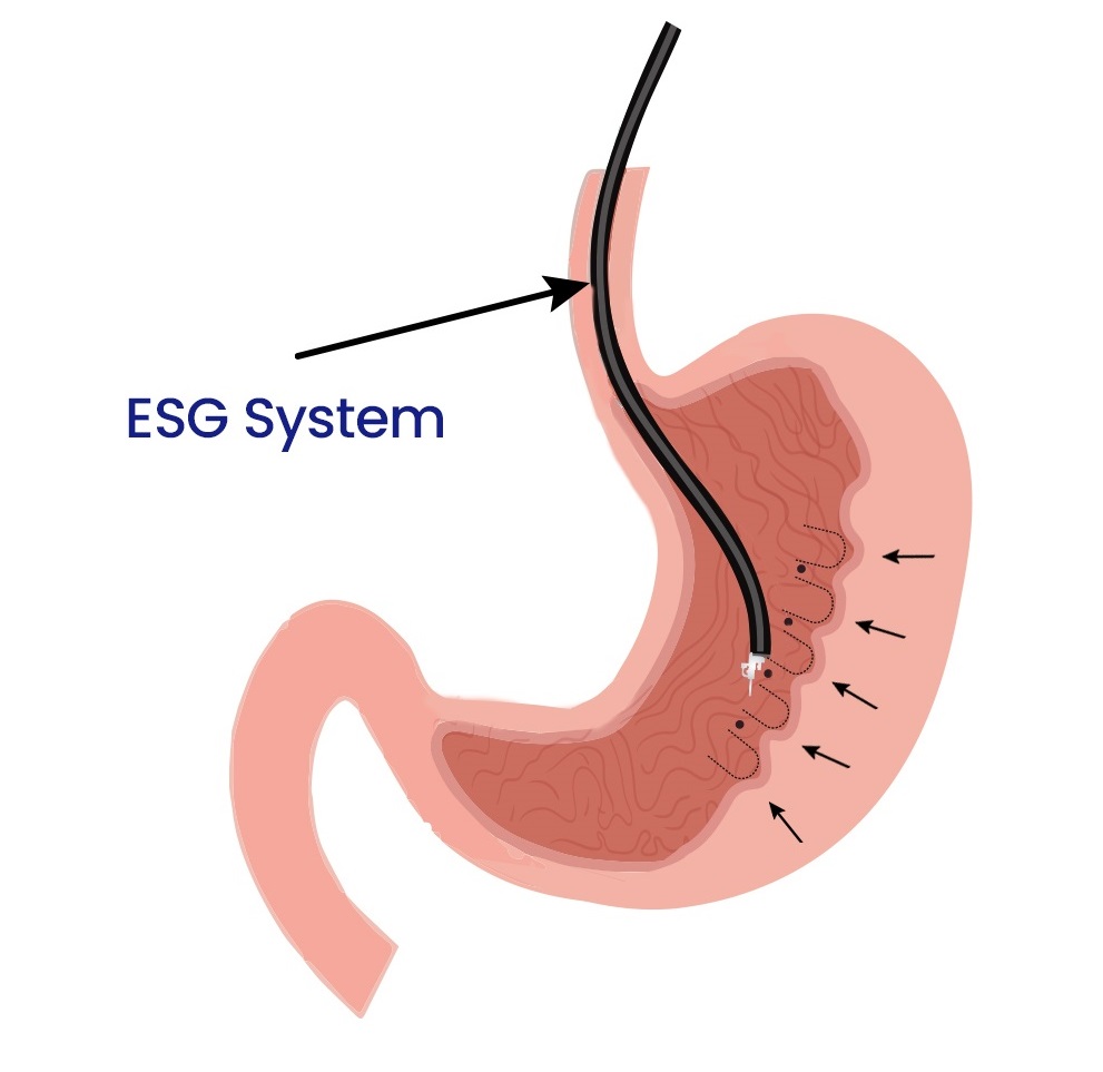 allurion gastric ballon services in kenya