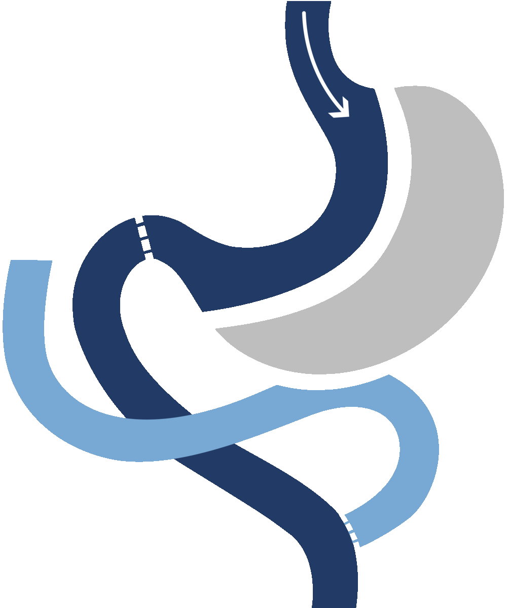 Duodenal Switch/ Biliopancreatic Diversion (DS/BPD) Halcyon